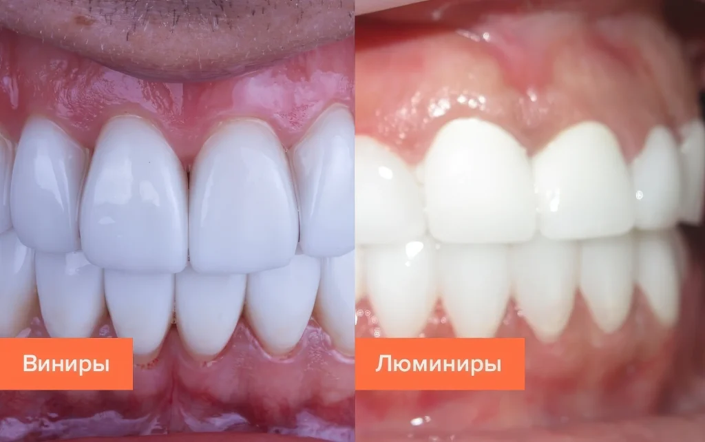 Виниры и люминиры