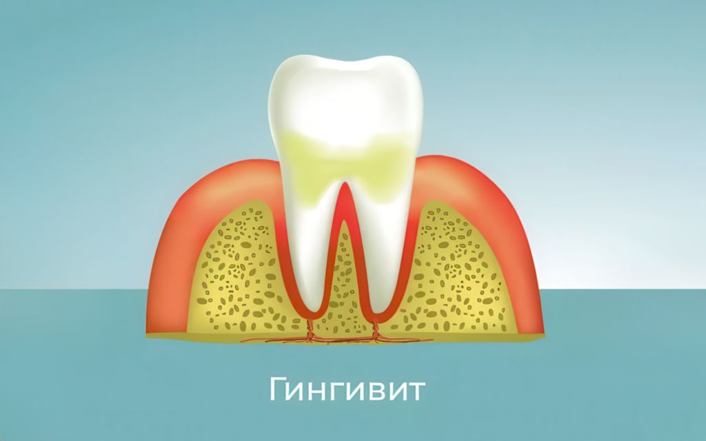 гингивит