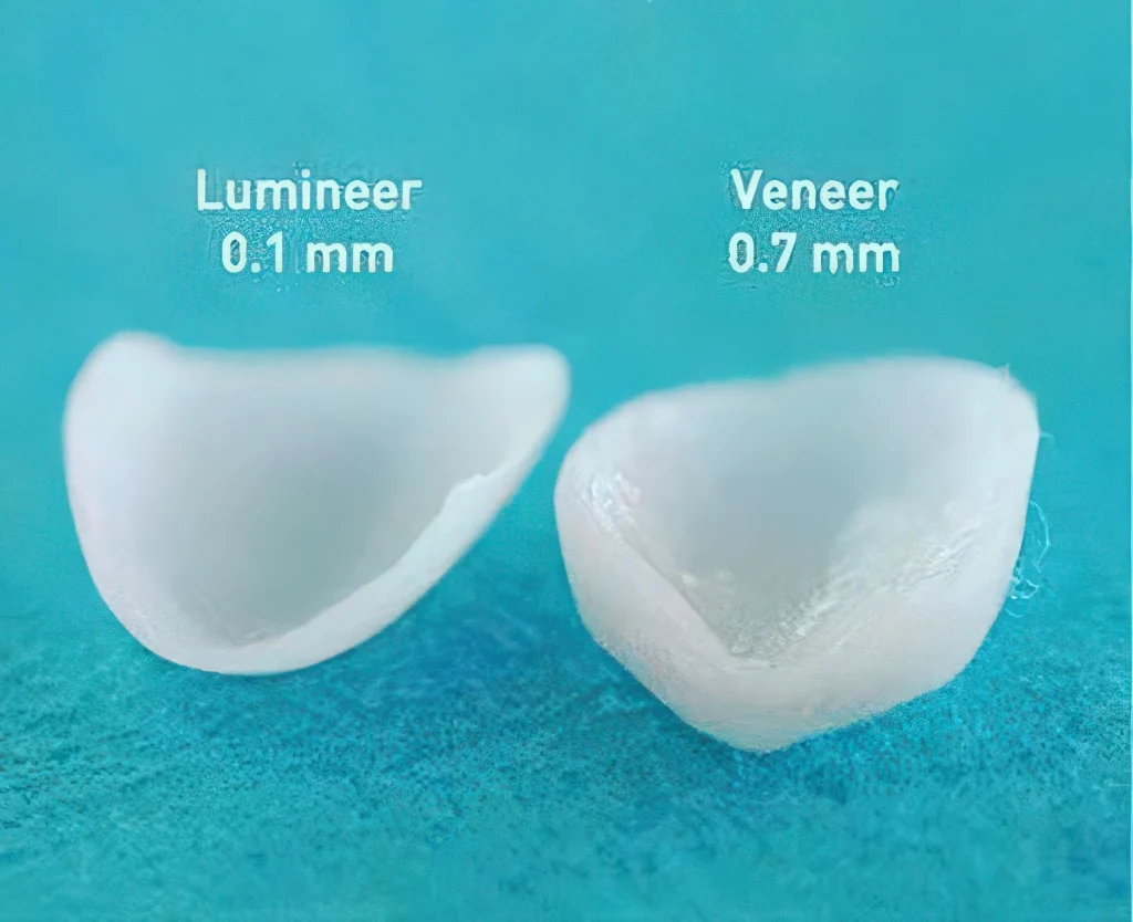 Veneers and Lumineers