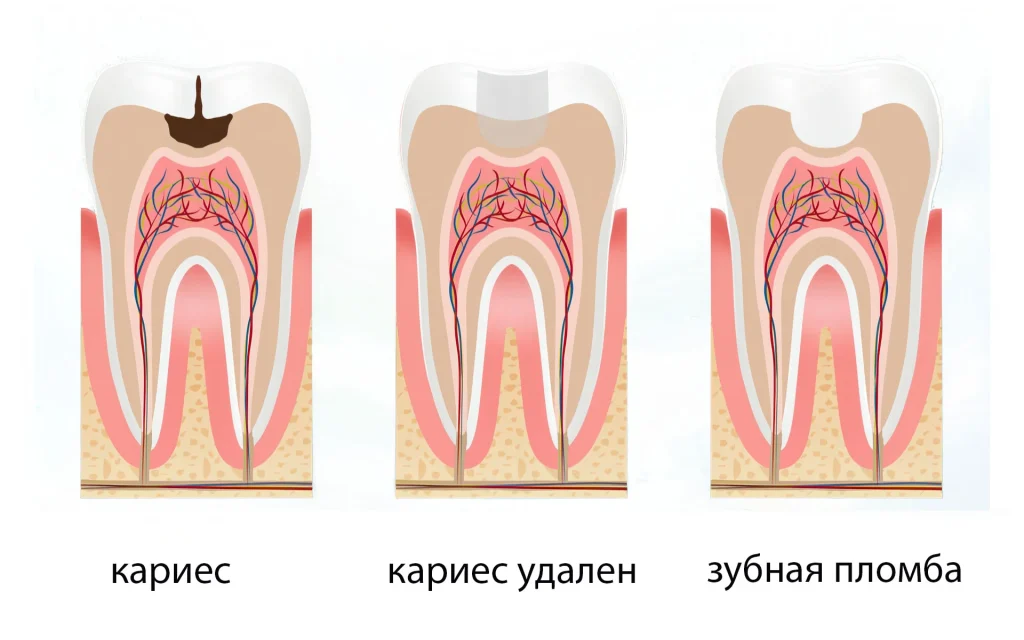 Лечение кариеса